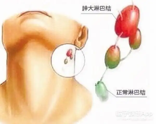 当脖子上冒出一颗颗小肉粒时正是身体发出的巨大警告