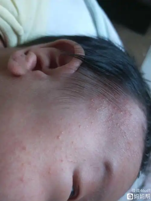 公式篇!宝宝湿疹"三三两两"-第1张图片-金凯博客