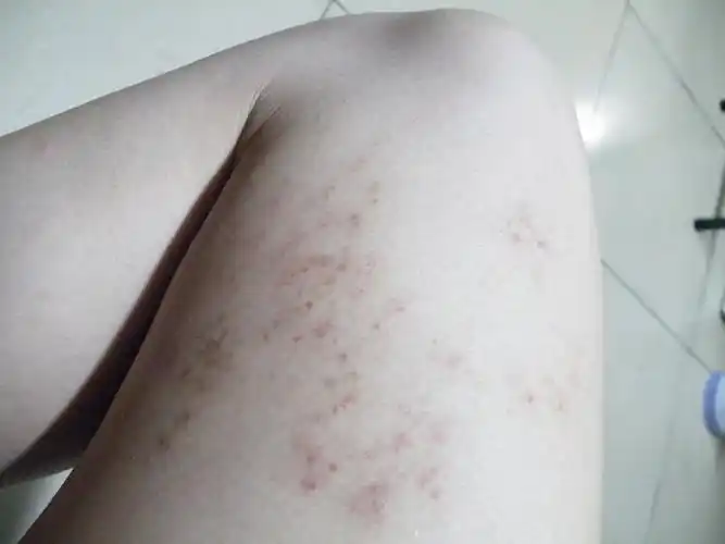 右腿内侧出现红色点状的血斑问题,日久会扩散,方向是