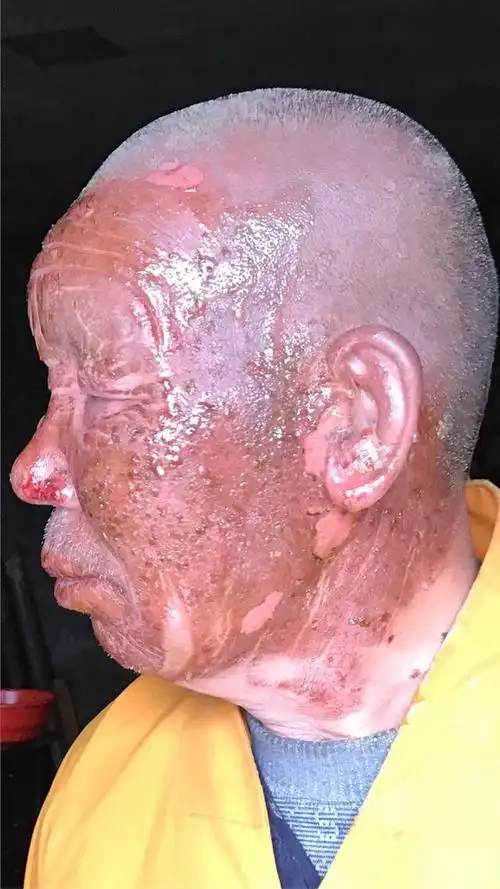 震惊整个朋友圈:寺庙和尚脸部烧伤,雪蜜治疗六天见奇效!