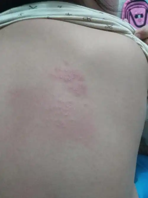 孩子十二岁后背起密集红色小疙瘩