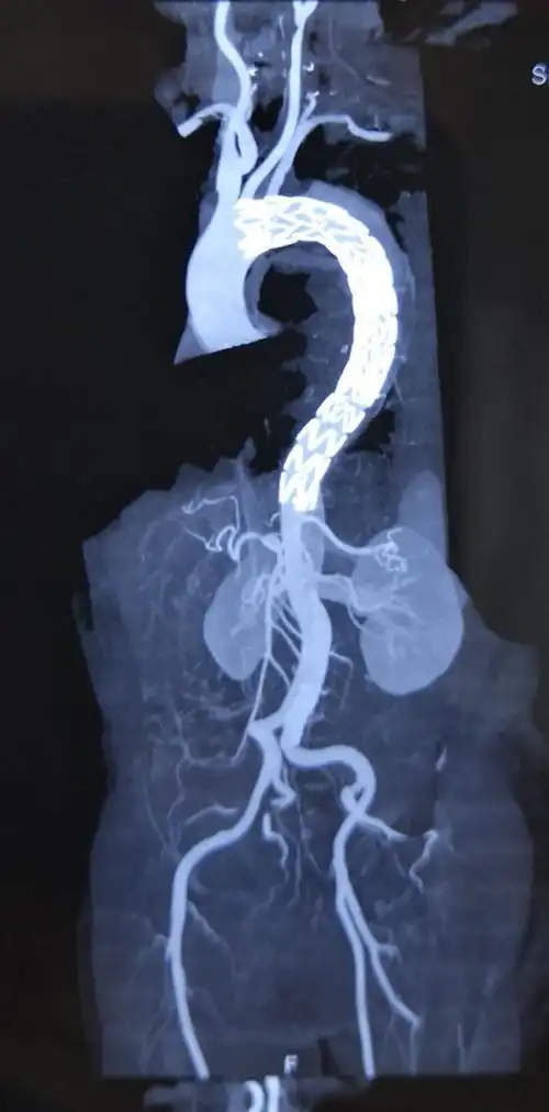 stanford b型主动脉夹层