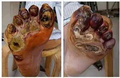 双足坏疽——糖尿病足患者及时治疗免截肢