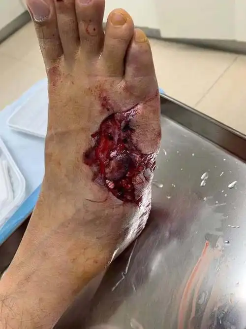 右游离股前外侧皮瓣修复右足背缺损