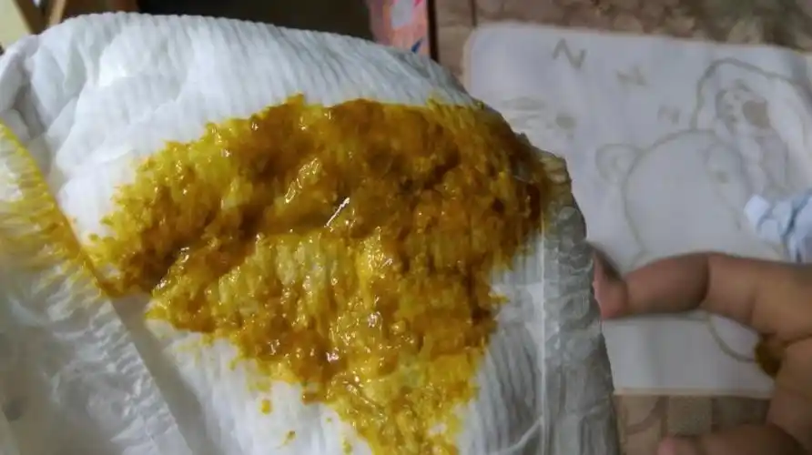 就去妇幼保健院验了大便(绿色泡沫粘液水便奶瓣