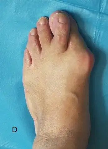 拇外翻_拇外翻疾病介绍 - 好大夫在线