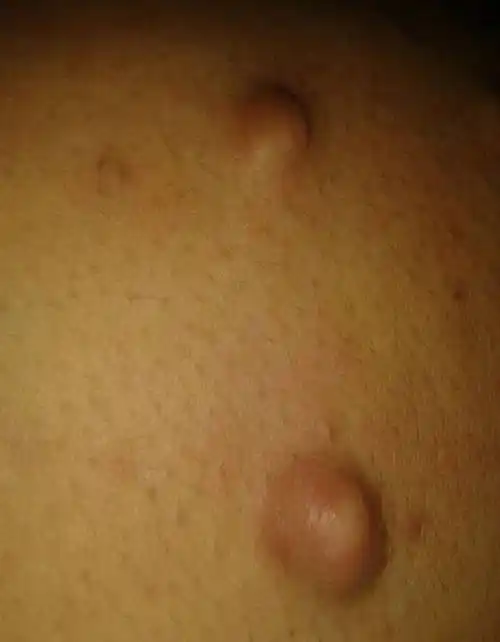 身上如果长有这几种疙瘩要特别小心,可能是病?看下你身上有吗?