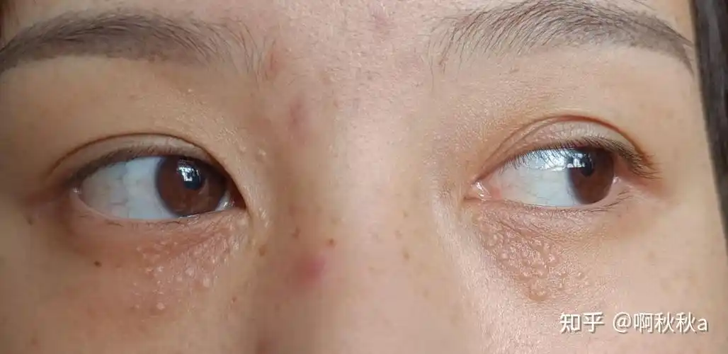 记录我的汗管瘤