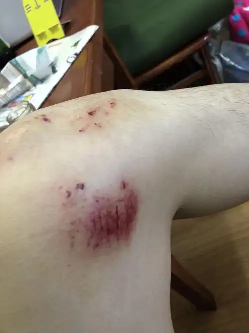 今天骑车,摔了一下,腿摔伤了破皮了,怎么样才能好的快 并且里面还有灰