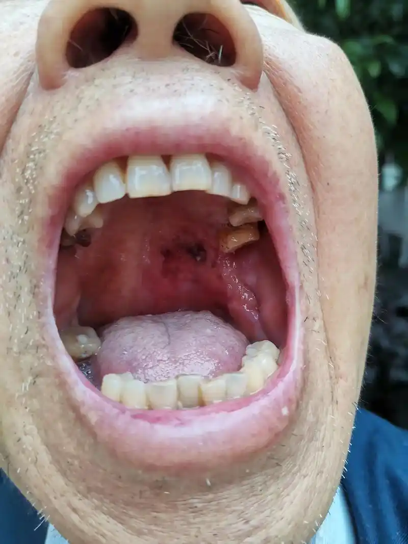 口腔癌长满微生物 - 抖音