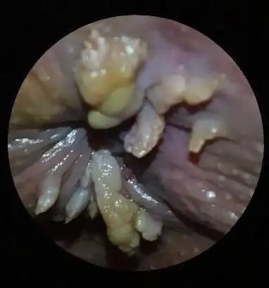 肛周尖锐湿疣 (42)