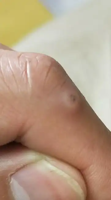 手指上长了个痘痘,不疼不痒,个头还不小,白色的,本人用针挑过,里面没