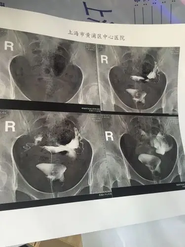 也没有流产过.到医院检查输卵管.片子如下.医生让我做手术.