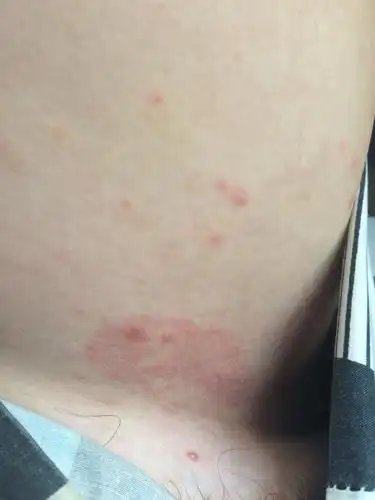 我人在国外大腿两内侧长了这些红的,我在网上查了,我怕是梅毒,这边