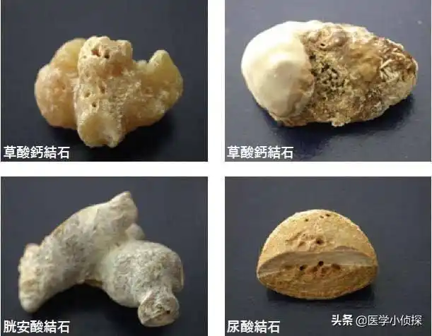 这个石头的成份有很多种,比如有草酸钙结石,磷酸钙结石,尿酸盐结石