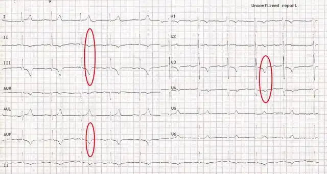 第二图:急性肺栓塞的心电图t波改变.