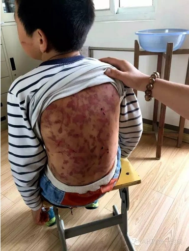 宁国9岁男孩被妈妈同居男友暴打 妈妈让邻居别管否则杀了孩子