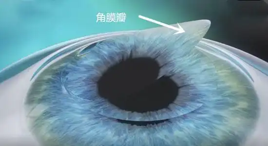 半飞秒手术先用飞秒激光代替机械刀制作角膜瓣,再用准分子激光进行