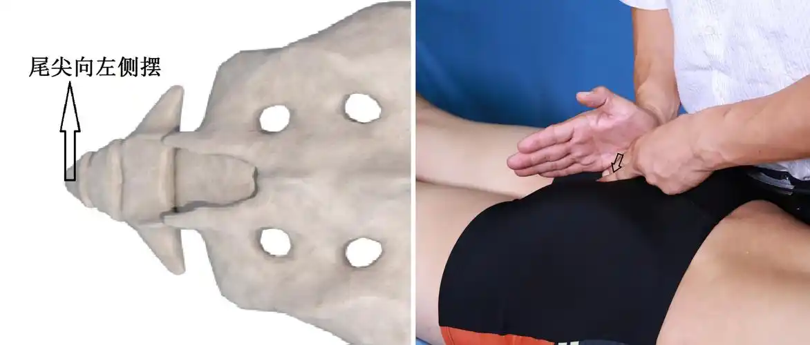 4-36如果向前按压尾骨出现疼痛,提示尾尖前移位(前屈加大).复位手法.