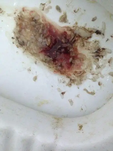 比较厉害的时候食物残渣容易造成食道黏膜的破损,而出现"吐血"的情况