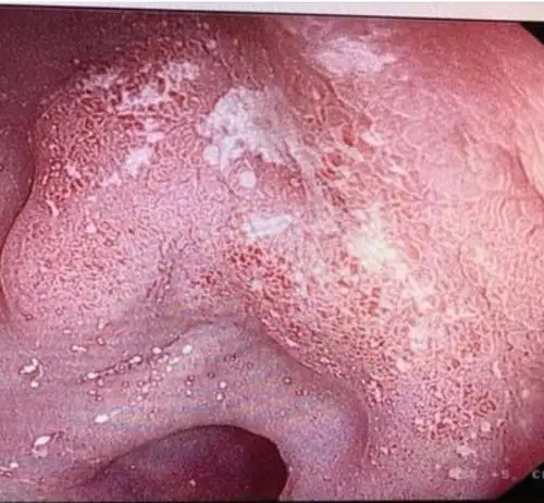 ↗浅表糜烂溃疡