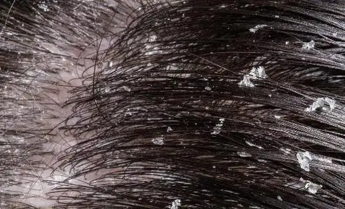头皮屑多是什么原因引起的 推荐6个有效去除头皮屑的小妙招-第4张图片