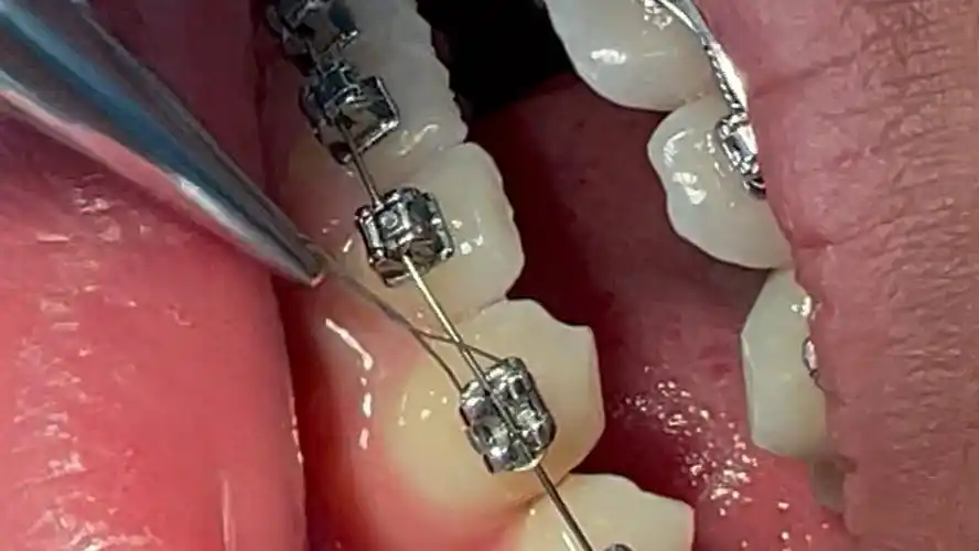 快速缠结扎丝 正畸