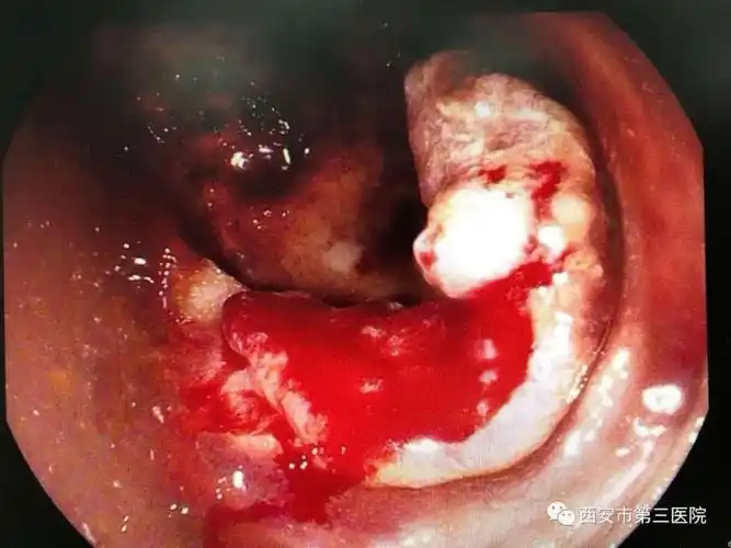 消化内科杨琦主任查看患者后表示,目前陈大爷存在活动性消化道大出血