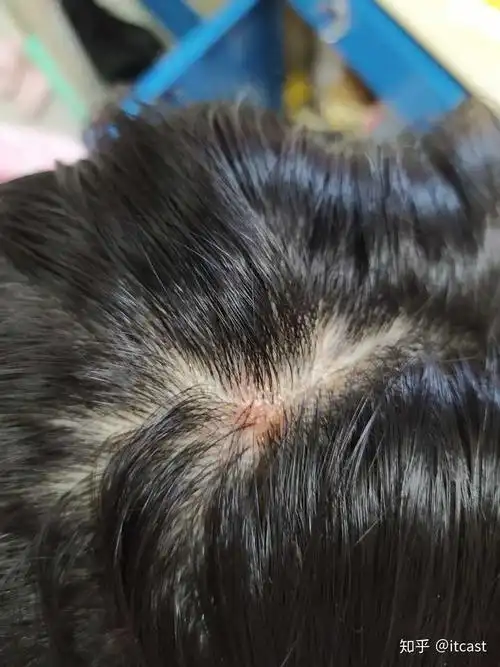 请问得了头部脂溢性皮炎 经常扣那些小疙瘩会怎么样.