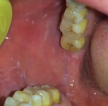 口腔扁平苔藓护理的措施