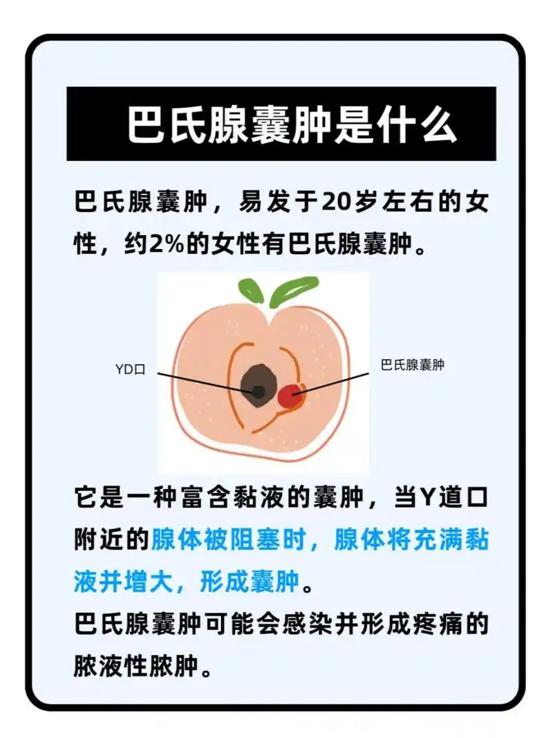自行抠破巴氏腺囊肿不仅可能导致感染,还可能因为破口的再次闭合而使