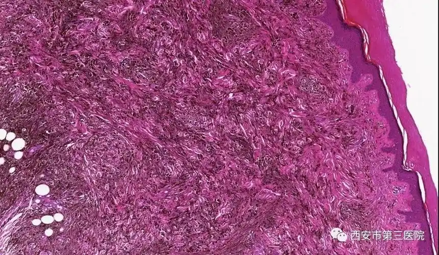 蓝痣模型示意图↑05蓝痣伍皮下见多量痣细胞呈腺样,束状,团巢状生长