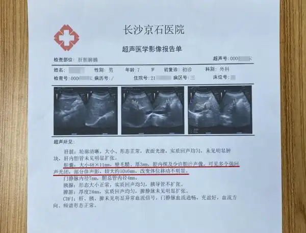 并接受了详细的术前检查,确诊小杰患有胆囊多发结石并胆囊炎,结石直径
