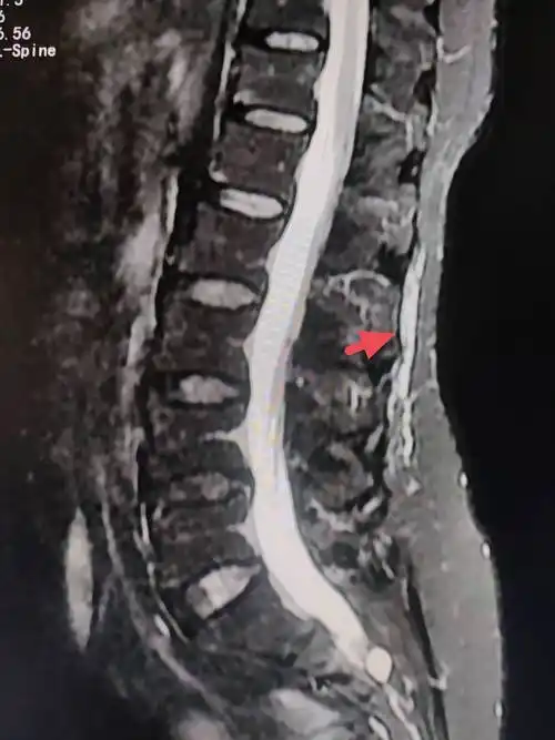 腰肌劳损_腰背_肌肉_信号
