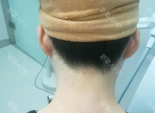 脱发际线好不好_效果图_谁予我孤独脱发际线术后第0天_新氧美容整形
