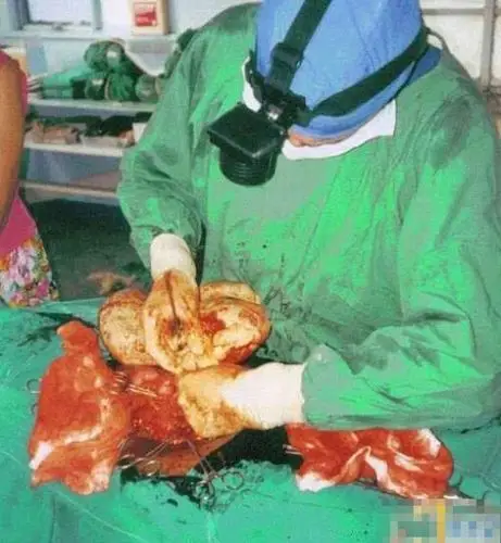 河南一妇女怀孕三年产下石婴?