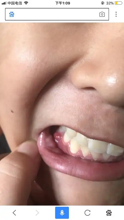 小朋友牙龈上长了个红包是怎么回事,该怎么解决