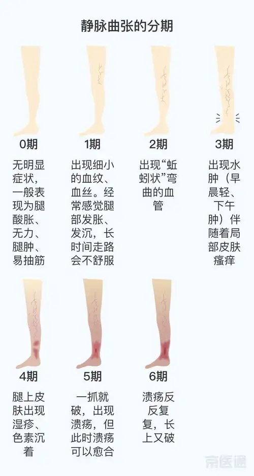 下肢静脉曲张