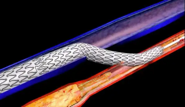 男儿膝下有支架 膝下动脉各类支架和国际临床试验结果大放送 - 好大夫