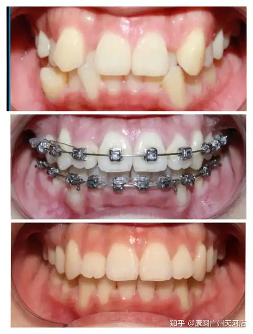 矫正案例分享牙齿拥挤