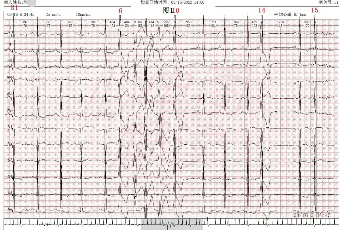 心电图分析: p波规律出现,在Ⅰ,Ⅱ,iii,avf