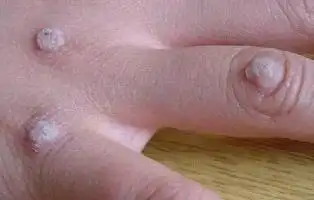 手背上突出的疙瘩,有可能是hpv感染长出的疣体吗健康指南_甲冉生官网