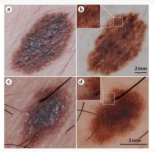 怎样分辨黑色素瘤和普通痣?