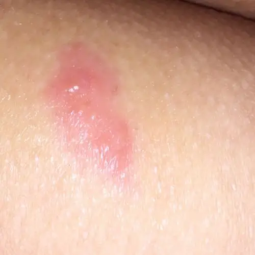 屁股上突然长了这个东西 有水泡 很疼 这是什么?