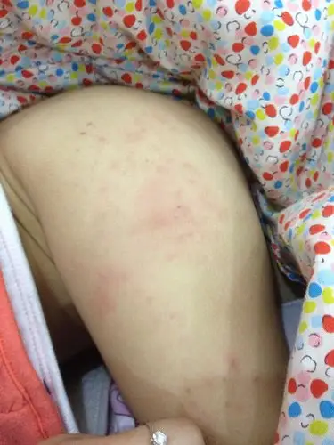 宝宝腿上痒,抓后出现一颗一颗的,不成片!