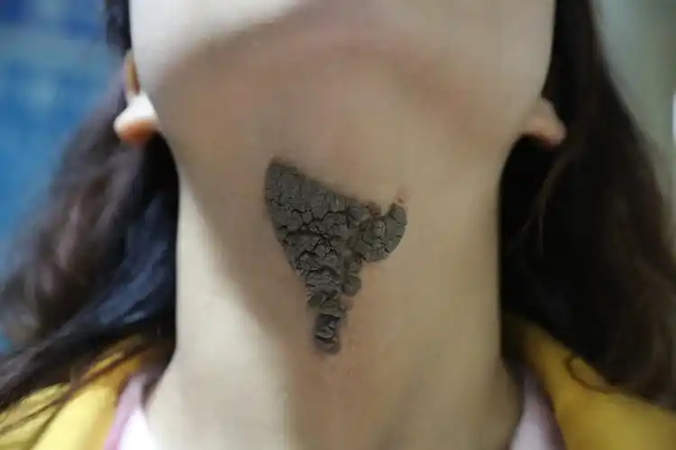 皮肤科完成一例颈部巨型皮脂腺痣切除术