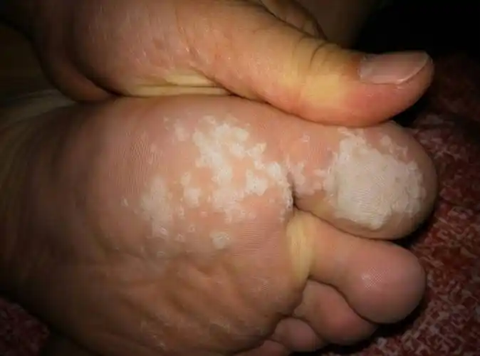 我的脚底长了好多密密麻麻的小窟窿 像白色的死皮 像鸡眼连成片了 谁