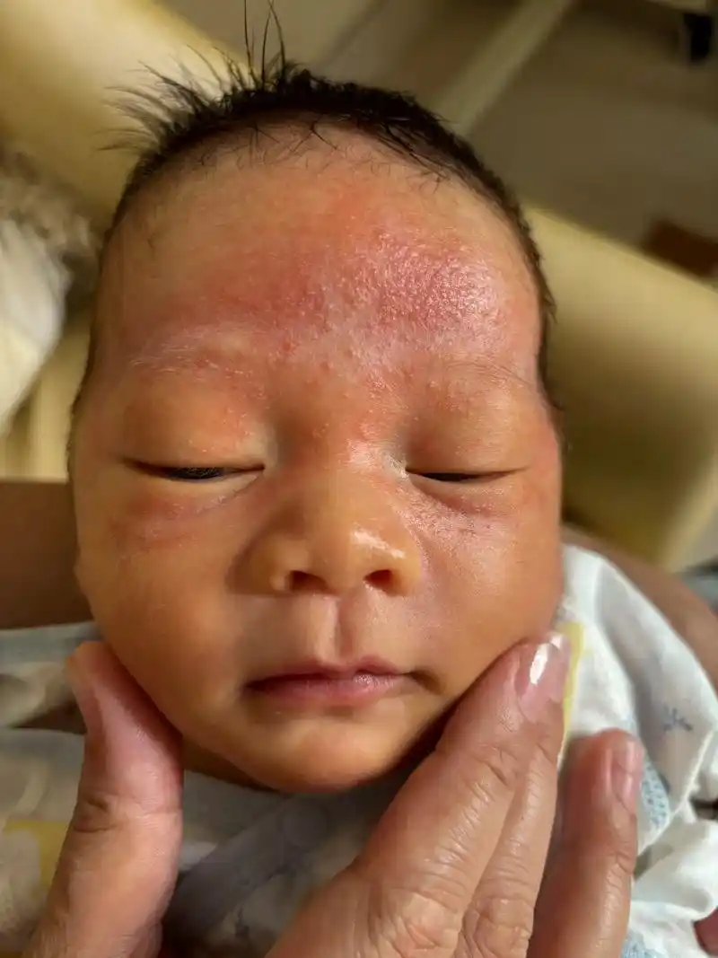 第18天的新问题:新生儿痤疮 湿疹