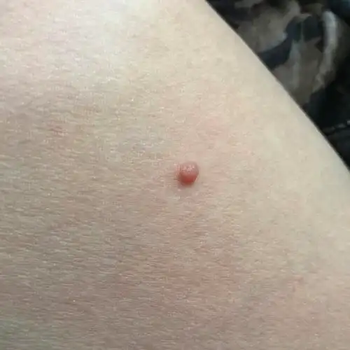 大腿内侧长一个圆又鼓的透明水样包,几年没变化,到底是啥?