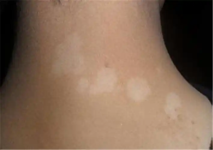 眼角白癜风早期症状图片